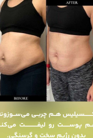 نمونه کار قبل و بعد دستگاه اکسیلیس در مجموعه اکسیر شهرک غرب